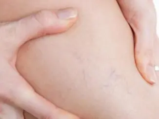 remedios caseros para la varices « ¿Se pueden prevenir y tratar la varices con remedios caseros?