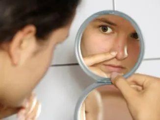 acne « Infusiones efectivas para tratar el acné