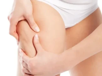Diferencia entre celulitis y adiposidad localizada